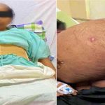 ५६ वर्षीय महिलाको पेटमा ४७ किलोको ट्यूमर !